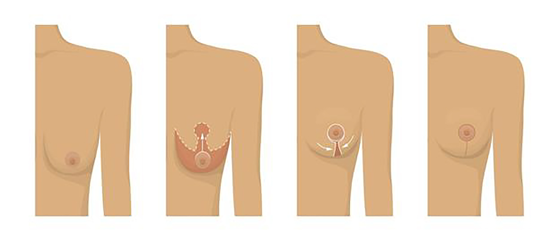 Nâng ngực sa trễ là phương pháp phẫu thuật nhằm loại bỏ da và mỡ thừa, đồng thời kéo căng các mô và cơ ở ngực lên.