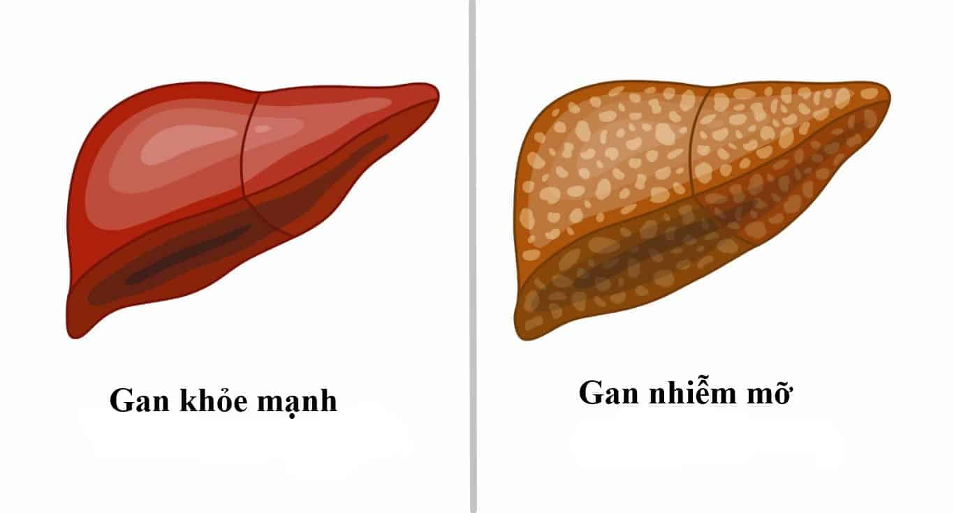 Gan nhiễm mỡ: Nguyên nhân, biểu hiện, điều trị và phòng bệnh