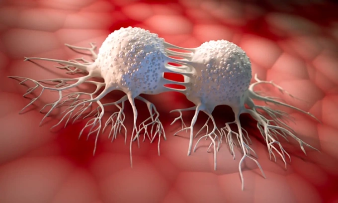Sarcoma Mô Bào Sau ung thư