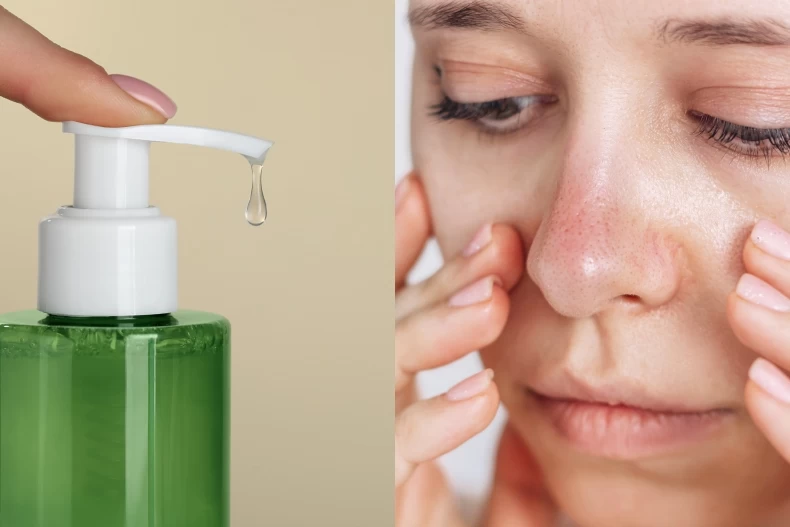 Mụn đầu đen: Khắc tinh của tài lộc và cách dọn sạch từ bác sĩ da liễu Hàn Quốc