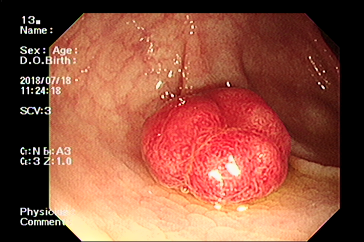 Ung thư dạ dày được phát hiện sớm hơn nhờ công nghệ mới, gia tăng cơ hội sống sót