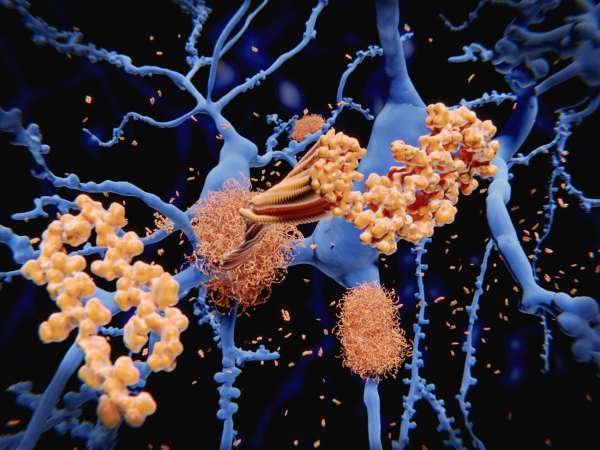 Bản đồ đột biến protein mở hướng điều trị bệnh Alzheimer - Hình ảnh minh họa