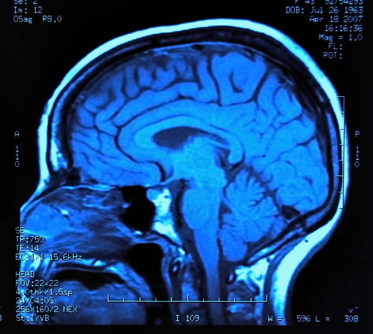 Bước đột phá: AI phát hiện sớm Parkinson với độ chính xác 88% chỉ qua video nụ cười - Hình ảnh minh họa